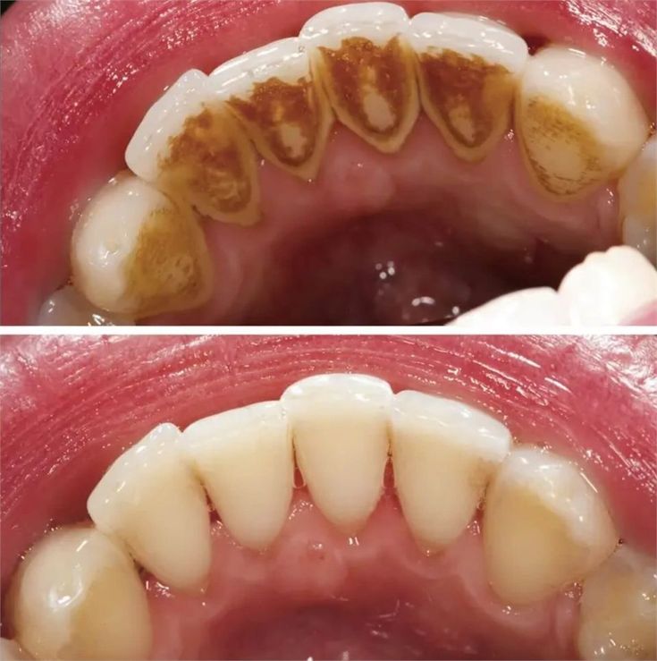 Teeth before whitening